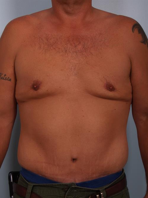 Male Liposuction After Photo | Phoenix and Scottsdale, AZ | Scottsdale Center for Plastic Surgery