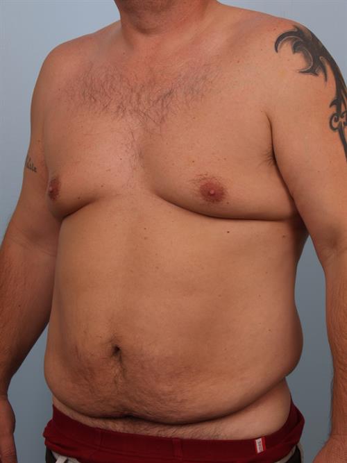 Tummy Tuck Before Photo | Phoenix and Scottsdale, AZ | Scottsdale Center for Plastic Surgery