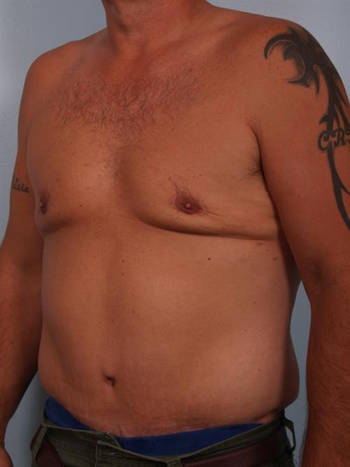 Tummy Tuck After Photo | Phoenix and Scottsdale, AZ | Scottsdale Center for Plastic Surgery