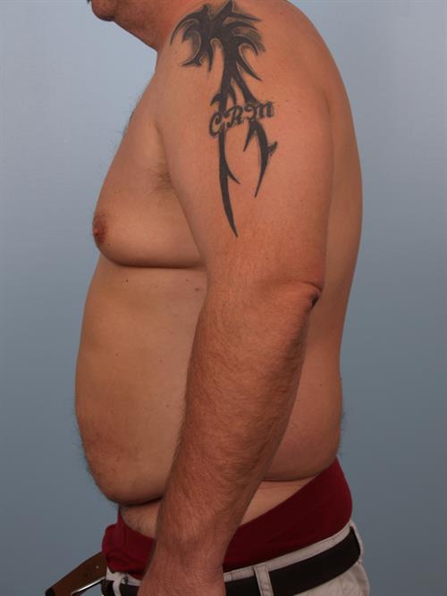 Tummy Tuck Before Photo | Phoenix and Scottsdale, AZ | Scottsdale Center for Plastic Surgery