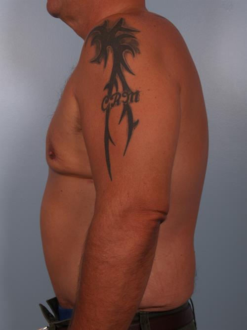 Tummy Tuck After Photo | Phoenix and Scottsdale, AZ | Scottsdale Center for Plastic Surgery