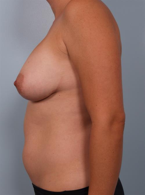 Revision Breast Surgery Before Photo | Phoenix and Scottsdale, AZ | Scottsdale Center for Plastic Surgery
