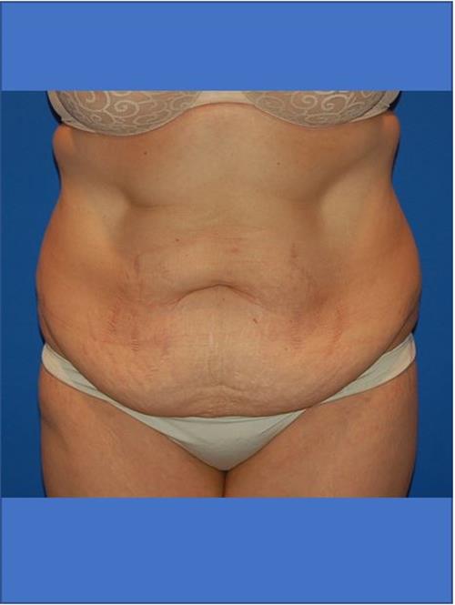 Tummy Tuck Before Photo | Phoenix and Scottsdale, AZ | Scottsdale Center for Plastic Surgery