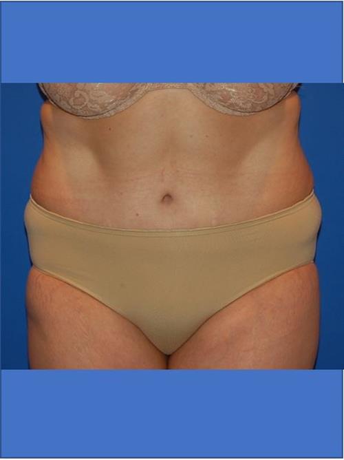 Tummy Tuck After Photo | Phoenix and Scottsdale, AZ | Scottsdale Center for Plastic Surgery