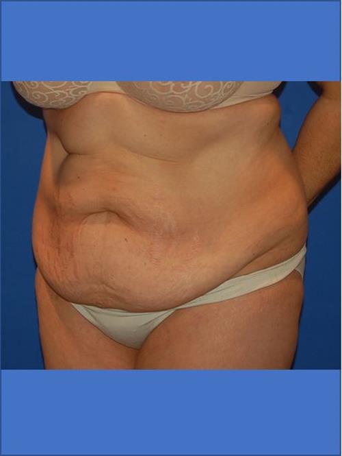 Tummy Tuck Before Photo | Phoenix and Scottsdale, AZ | Scottsdale Center for Plastic Surgery