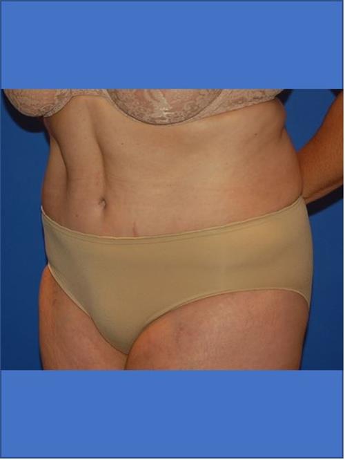Tummy Tuck After Photo | Phoenix and Scottsdale, AZ | Scottsdale Center for Plastic Surgery