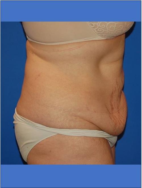 Tummy Tuck Before Photo | Phoenix and Scottsdale, AZ | Scottsdale Center for Plastic Surgery
