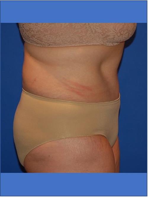 Tummy Tuck After Photo | Phoenix and Scottsdale, AZ | Scottsdale Center for Plastic Surgery
