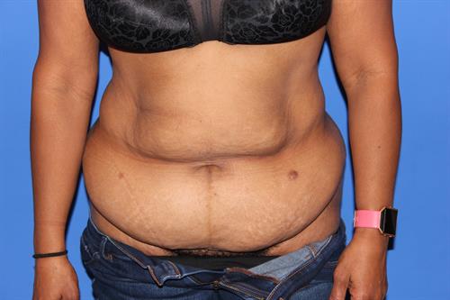 Tummy Tuck Before Photo | Phoenix and Scottsdale, AZ | Scottsdale Center for Plastic Surgery
