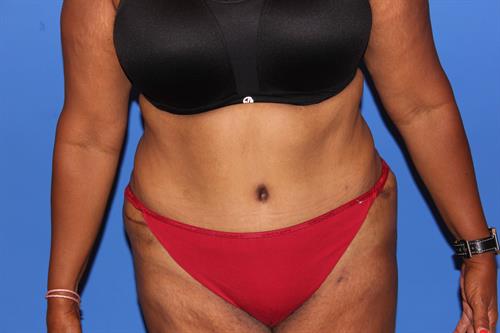 Tummy Tuck After Photo | Phoenix and Scottsdale, AZ | Scottsdale Center for Plastic Surgery