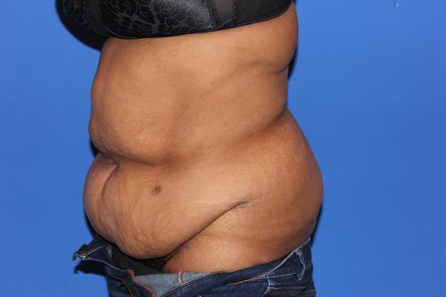 Tummy Tuck Before Photo | Phoenix and Scottsdale, AZ | Scottsdale Center for Plastic Surgery