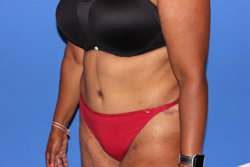 Tummy Tuck After Photo | Phoenix and Scottsdale, AZ | Scottsdale Center for Plastic Surgery
