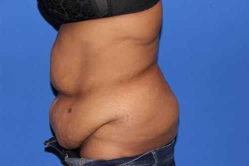 Tummy Tuck Before Photo | Phoenix and Scottsdale, AZ | Scottsdale Center for Plastic Surgery
