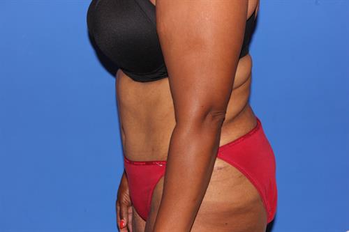Tummy Tuck After Photo | Phoenix and Scottsdale, AZ | Scottsdale Center for Plastic Surgery