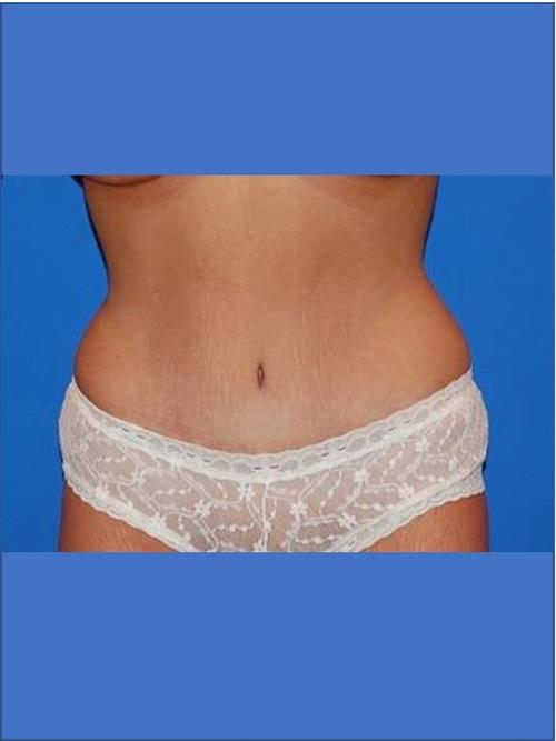 Tummy Tuck After Photo | Phoenix and Scottsdale, AZ | Scottsdale Center for Plastic Surgery