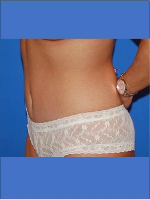 Tummy Tuck After Photo | Phoenix and Scottsdale, AZ | Scottsdale Center for Plastic Surgery