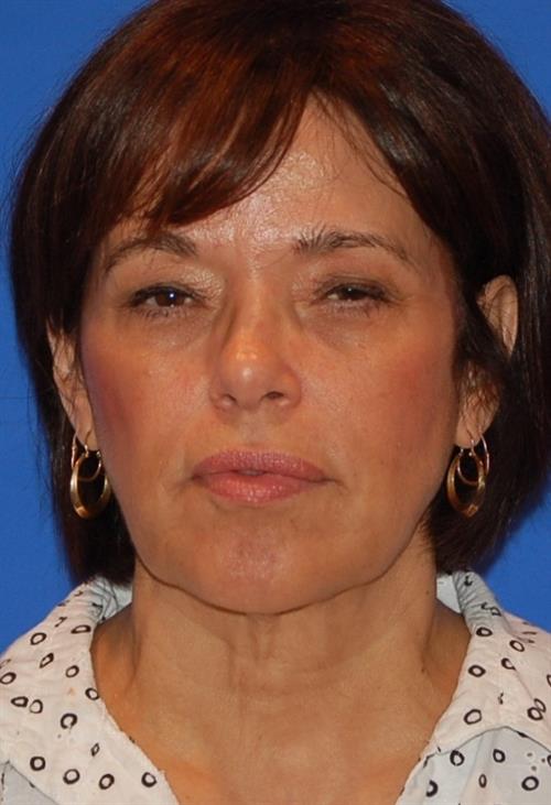Facelift/Necklift Before Photo | Phoenix and Scottsdale, AZ | Scottsdale Center for Plastic Surgery