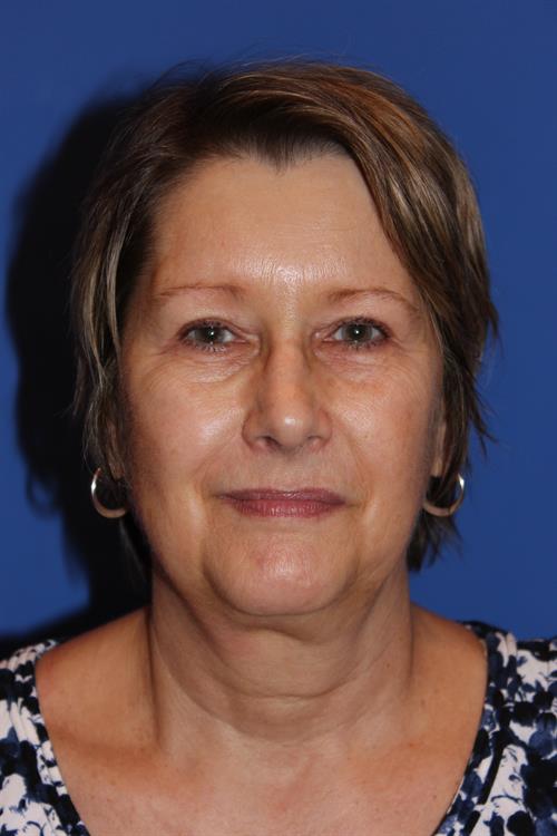 Facelift/Necklift Before Photo | Phoenix and Scottsdale, AZ | Scottsdale Center for Plastic Surgery