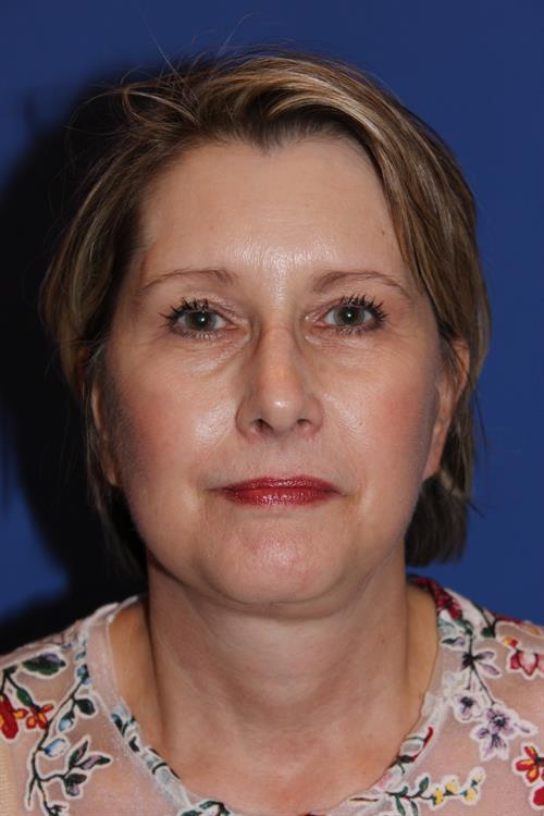 Facelift/Necklift After Photo | Phoenix and Scottsdale, AZ | Scottsdale Center for Plastic Surgery