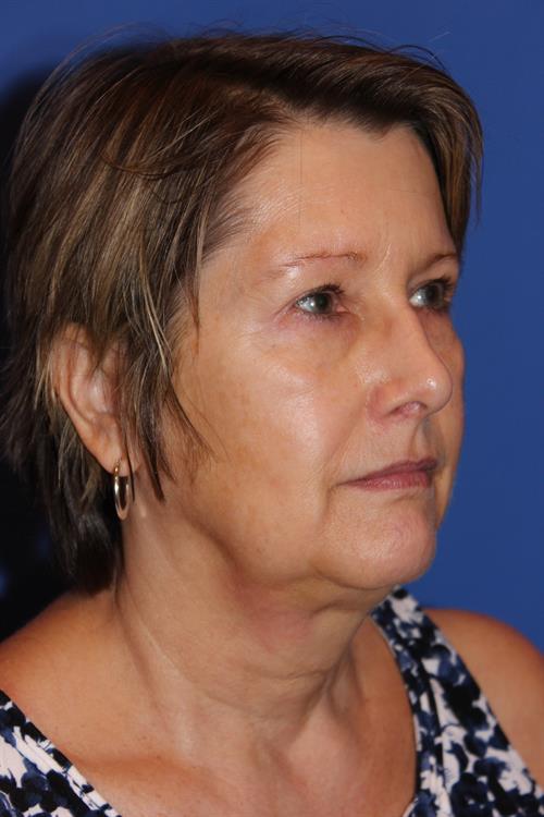 Facelift/Necklift Before Photo | Phoenix and Scottsdale, AZ | Scottsdale Center for Plastic Surgery
