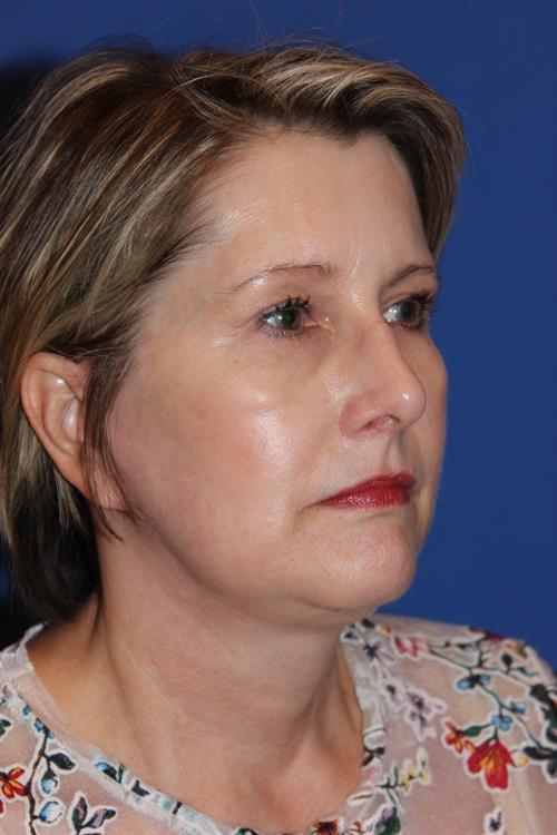 Facelift/Necklift After Photo | Phoenix and Scottsdale, AZ | Scottsdale Center for Plastic Surgery