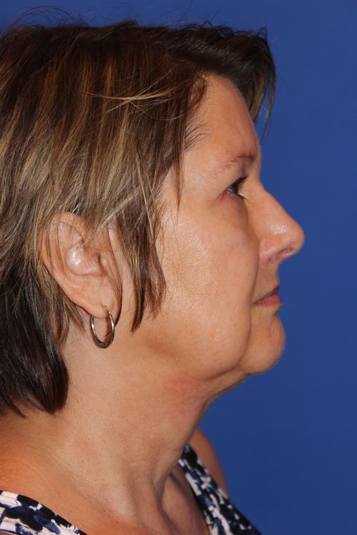 Facelift/Necklift Before Photo | Phoenix and Scottsdale, AZ | Scottsdale Center for Plastic Surgery