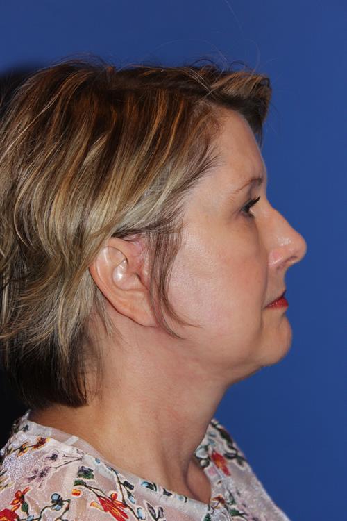 Facelift/Necklift After Photo | Phoenix and Scottsdale, AZ | Scottsdale Center for Plastic Surgery