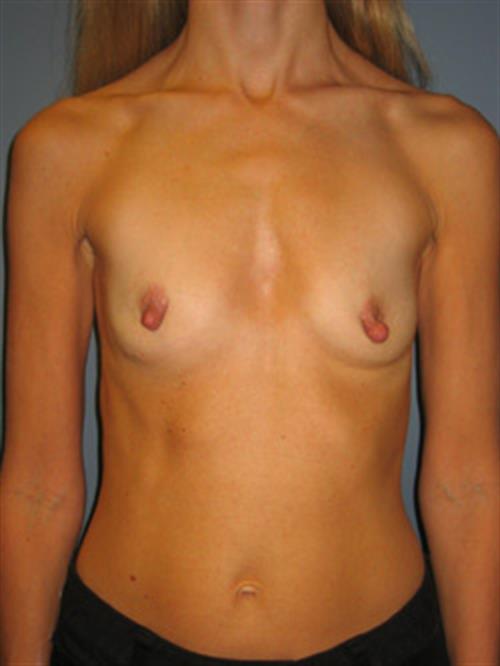 Breast Augmentation Before Photo | Phoenix and Scottsdale, AZ | Scottsdale Center for Plastic Surgery