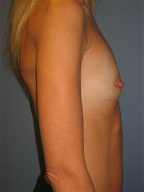 Breast Augmentation Before Photo | Phoenix and Scottsdale, AZ | Scottsdale Center for Plastic Surgery