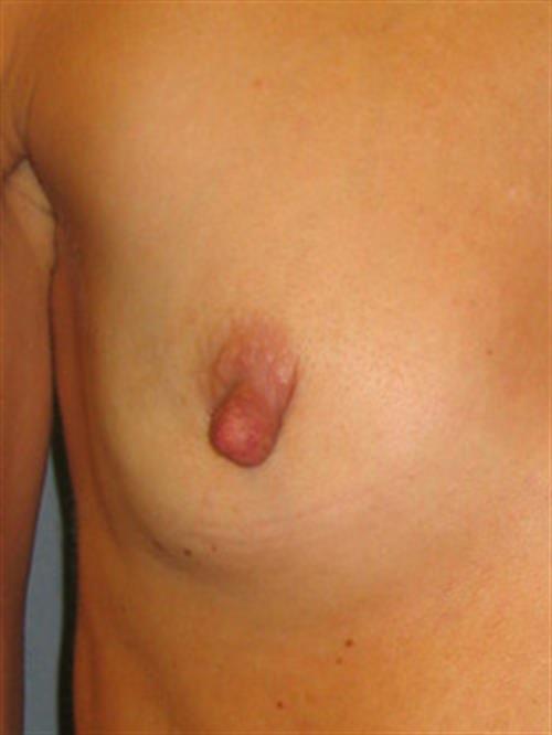 Breast Augmentation Before Photo | Phoenix and Scottsdale, AZ | Scottsdale Center for Plastic Surgery