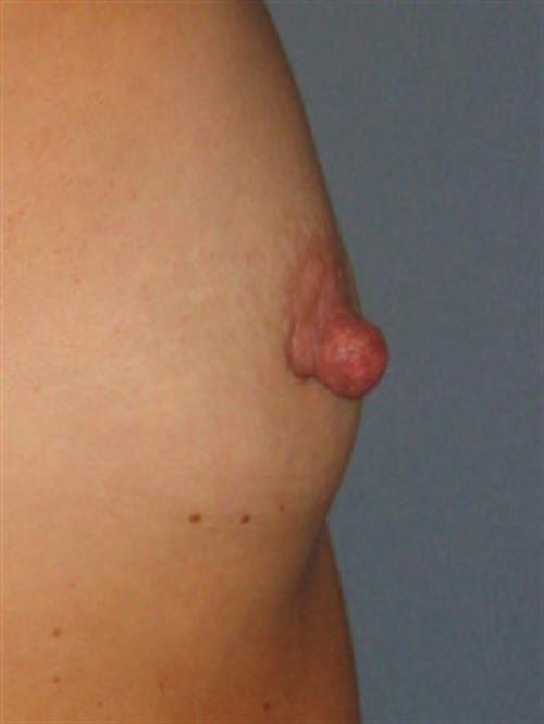 Breast Augmentation Before Photo | Phoenix and Scottsdale, AZ | Scottsdale Center for Plastic Surgery