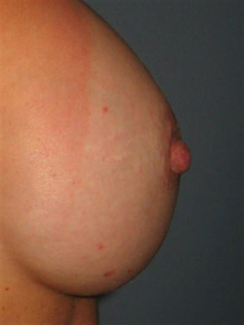 Breast Augmentation After Photo | Phoenix and Scottsdale, AZ | Scottsdale Center for Plastic Surgery