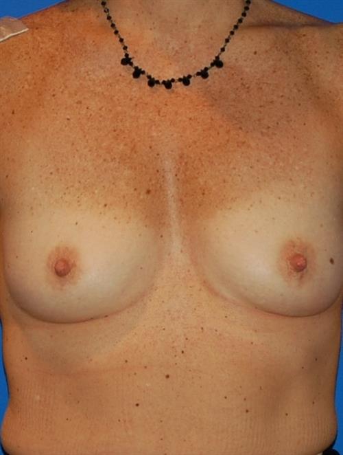 Breast Augmentation Before Photo | Phoenix and Scottsdale, AZ | Scottsdale Center for Plastic Surgery