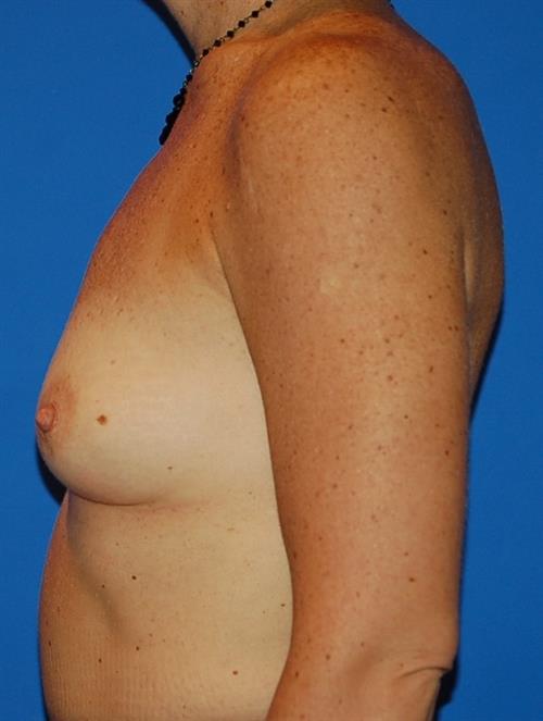 Breast Augmentation Before Photo | Phoenix and Scottsdale, AZ | Scottsdale Center for Plastic Surgery
