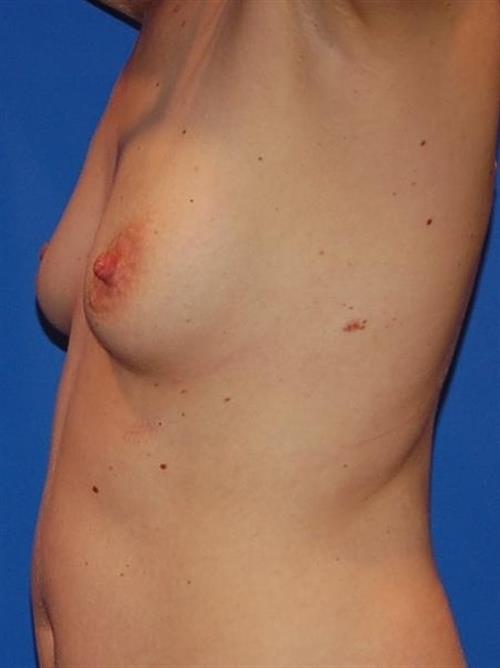 Breast Augmentation Before Photo | Phoenix and Scottsdale, AZ | Scottsdale Center for Plastic Surgery