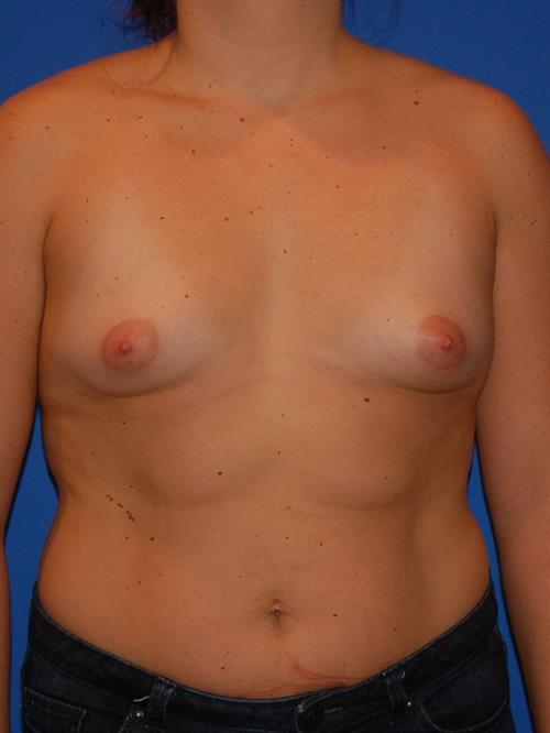 Breast Augmentation Before Photo | Paradise Valley, AZ | Scottsdale Center for Plastic Surgery