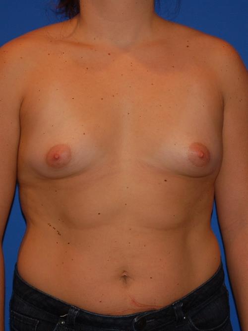 Breast Augmentation Before Photo | ,  | 