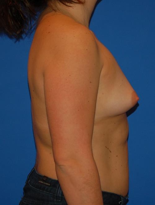 Sub-Fascial Breast Augmentation Before Photo | ,  | 