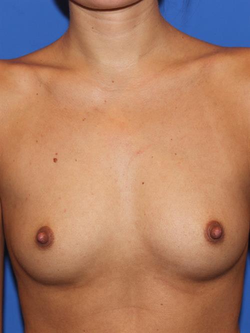 Sub-Fascial Breast Augmentation Before Photo | Phoenix and Scottsdale, AZ | Scottsdale Center for Plastic Surgery