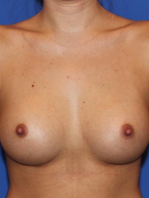 Sub-Fascial Breast Augmentation After Photo | Phoenix and Scottsdale, AZ | Scottsdale Center for Plastic Surgery