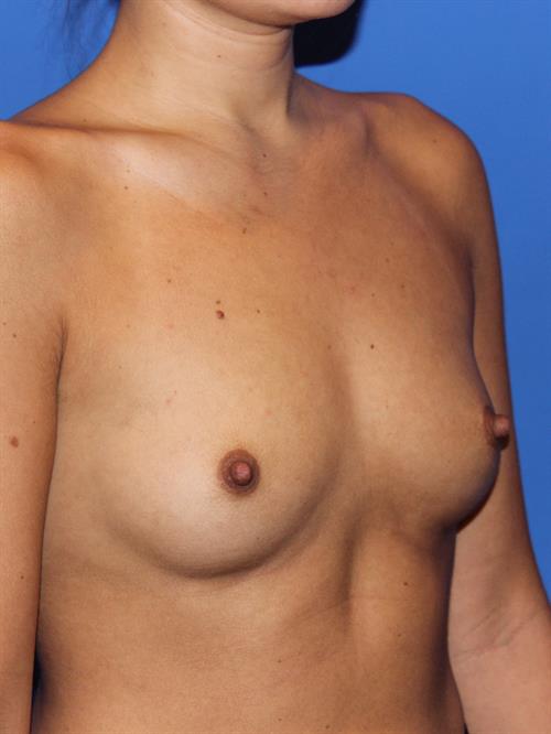 Breast Augmentation Before Photo | Phoenix and Scottsdale, AZ | Scottsdale Center for Plastic Surgery