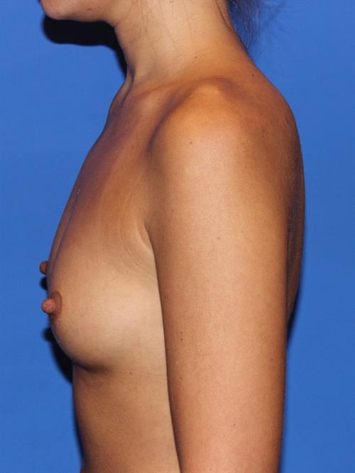 Breast Augmentation Before Photo | Phoenix and Scottsdale, AZ | Scottsdale Center for Plastic Surgery