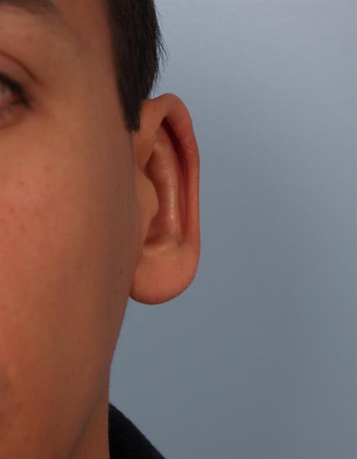 Otoplasty (Ear Reshaping) After Photo | Phoenix and Scottsdale, AZ | Scottsdale Center for Plastic Surgery