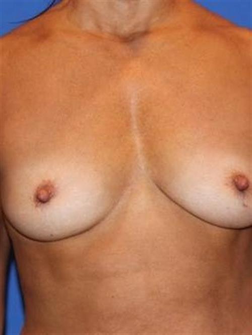 Sub-Fascial Breast Augmentation Before Photo | Phoenix and Scottsdale, AZ | Scottsdale Center for Plastic Surgery