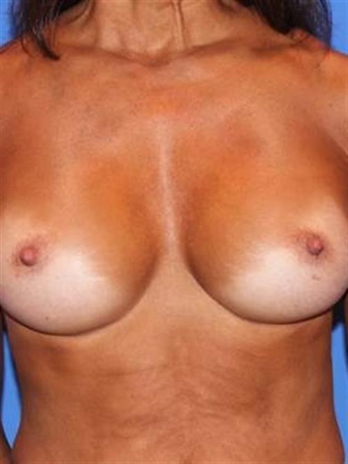 Sub-Fascial Breast Augmentation After Photo | Phoenix and Scottsdale, AZ | Scottsdale Center for Plastic Surgery