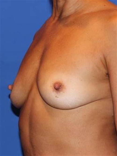 Sub-Fascial Breast Augmentation Before Photo | Phoenix and Scottsdale, AZ | Scottsdale Center for Plastic Surgery