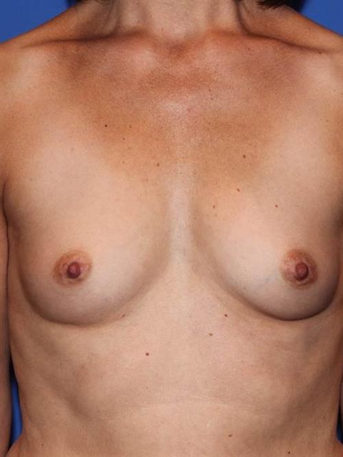 Breast Augmentation Before Photo | Phoenix and Scottsdale, AZ | Scottsdale Center for Plastic Surgery
