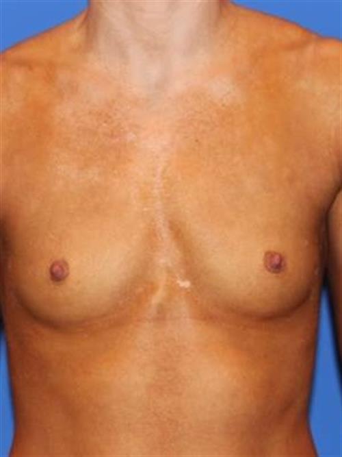 Breast Augmentation Before Photo | Phoenix and Scottsdale, AZ | Scottsdale Center for Plastic Surgery