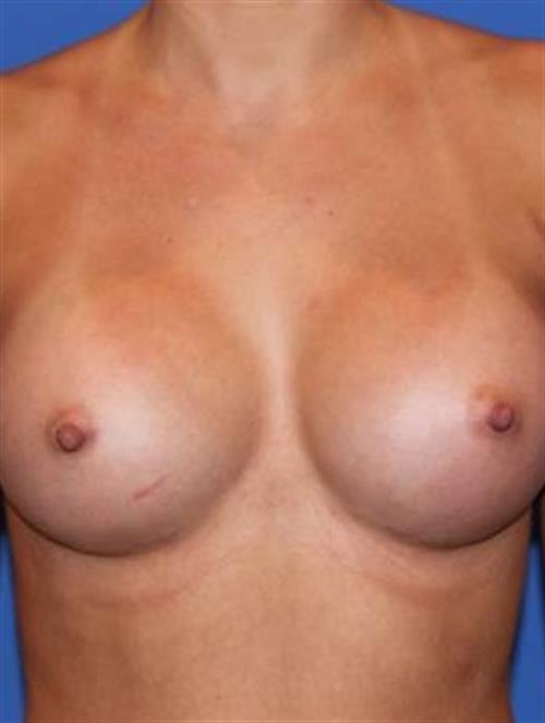 Breast Augmentation After Photo | Phoenix and Scottsdale, AZ | Scottsdale Center for Plastic Surgery