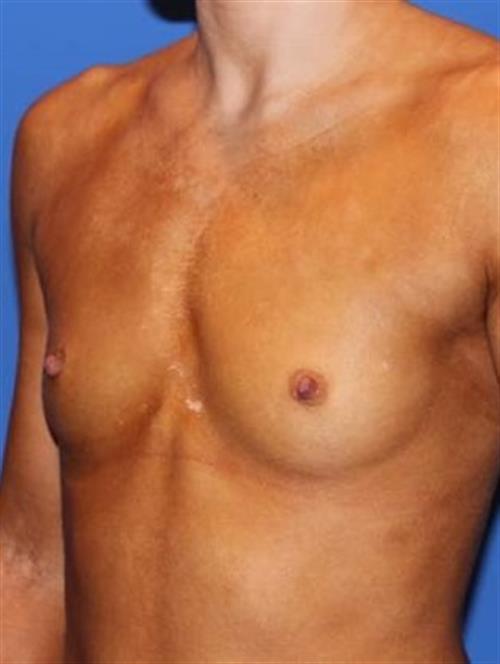 Breast Augmentation Before Photo | Phoenix and Scottsdale, AZ | Scottsdale Center for Plastic Surgery